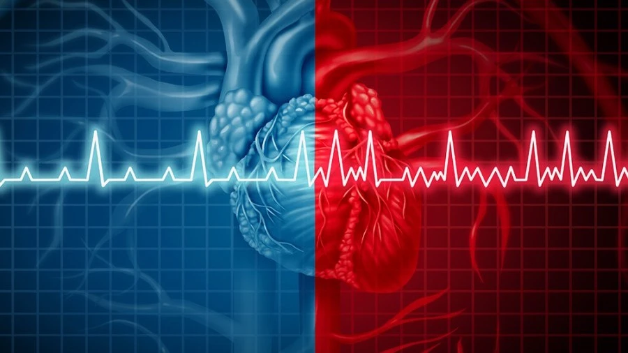 Atrial fibrillation