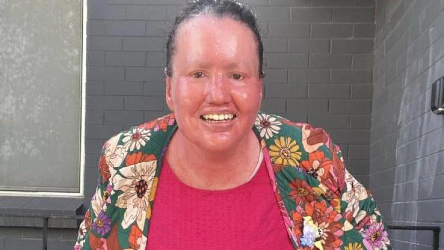 Carly Findlay OAM