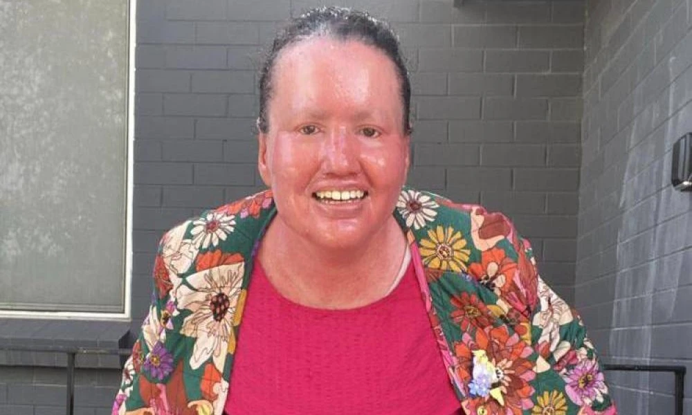Carly Findlay OAM