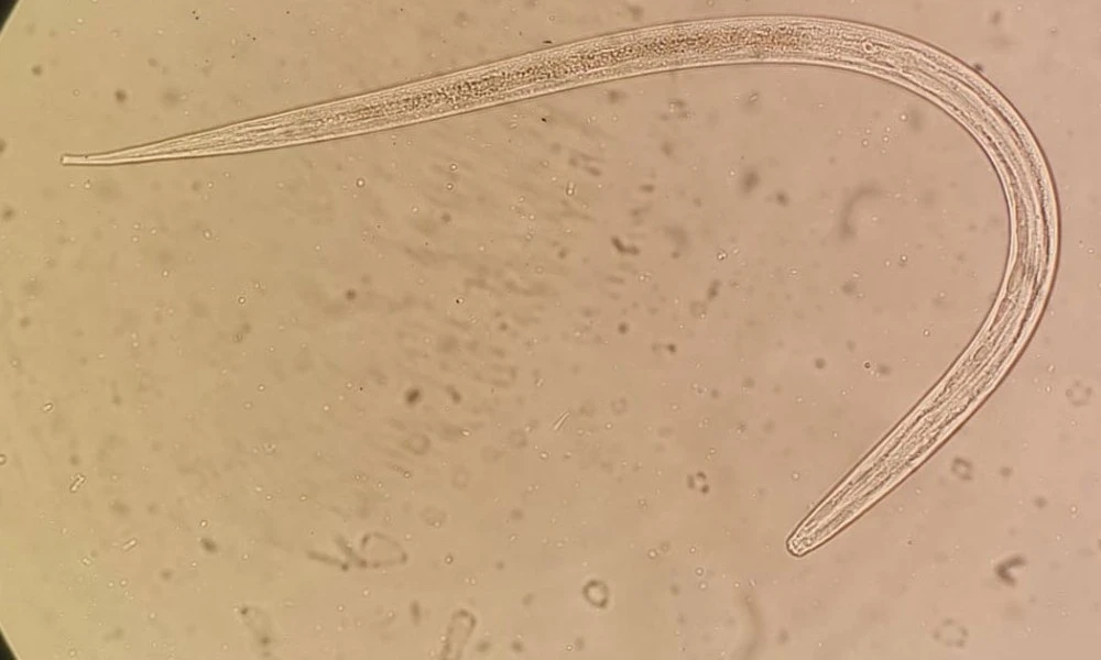 Microscopic view of strongyloidiasis
