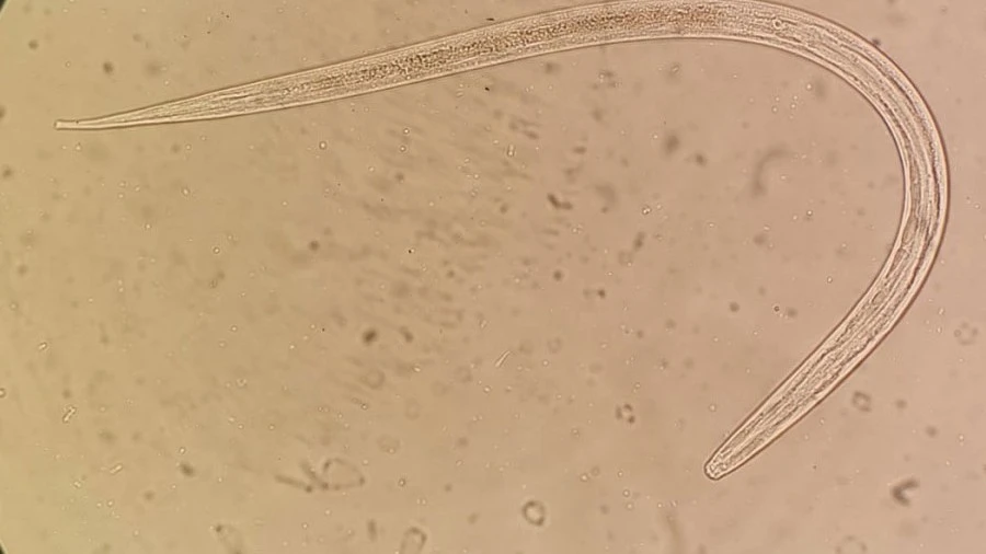 Microscopic view of strongyloidiasis